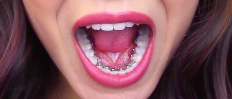 Lingual Braces Nedir