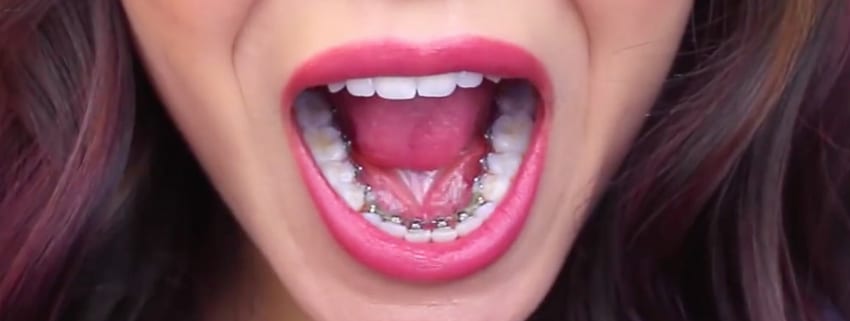 Lingual Braces Nedir